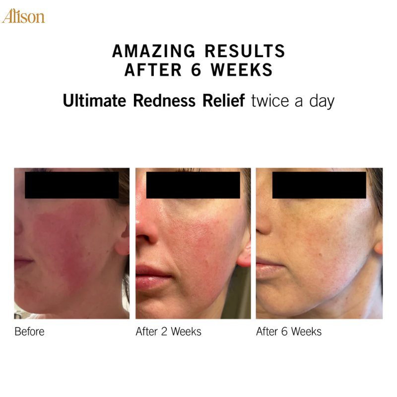 Neova Ultimate Redness Relief